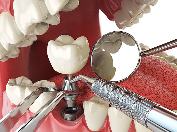 Best Emergency Dentist for Lost Fillings or Crowns in Ansted, WV